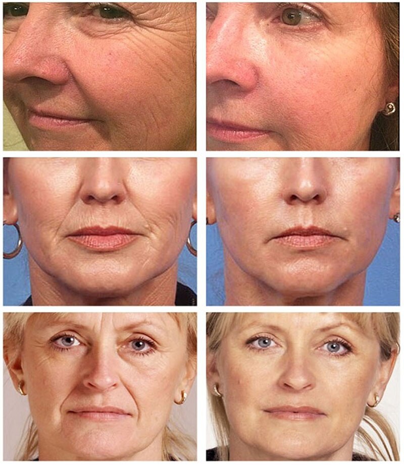 Breylee Face Repair Cream Vitamin C 20% - 40g - Discount Applied